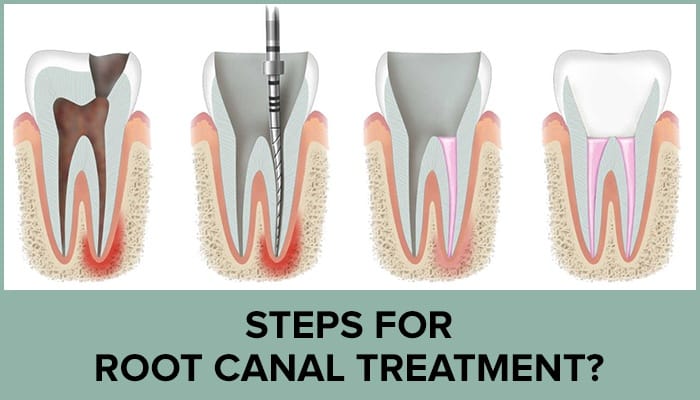 Steps For Root Canal Treatment