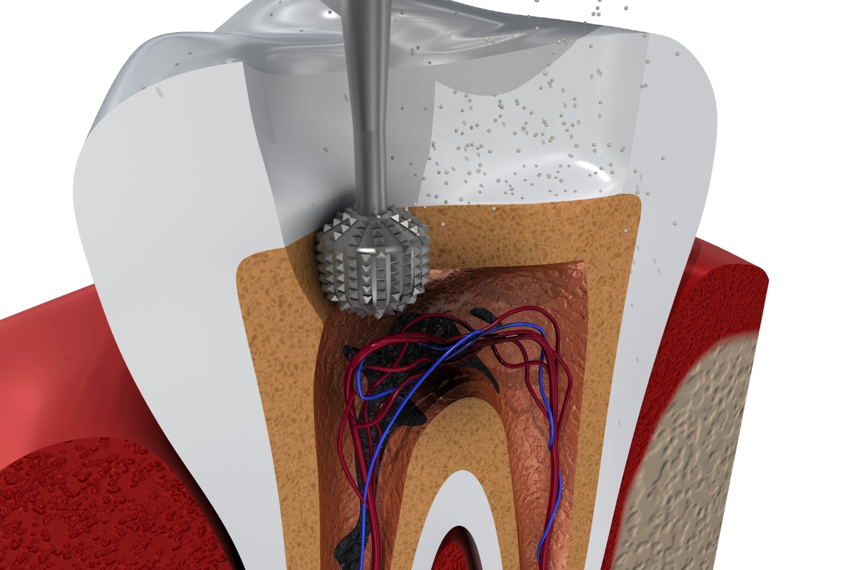 Root Canal Therapy In Richmond