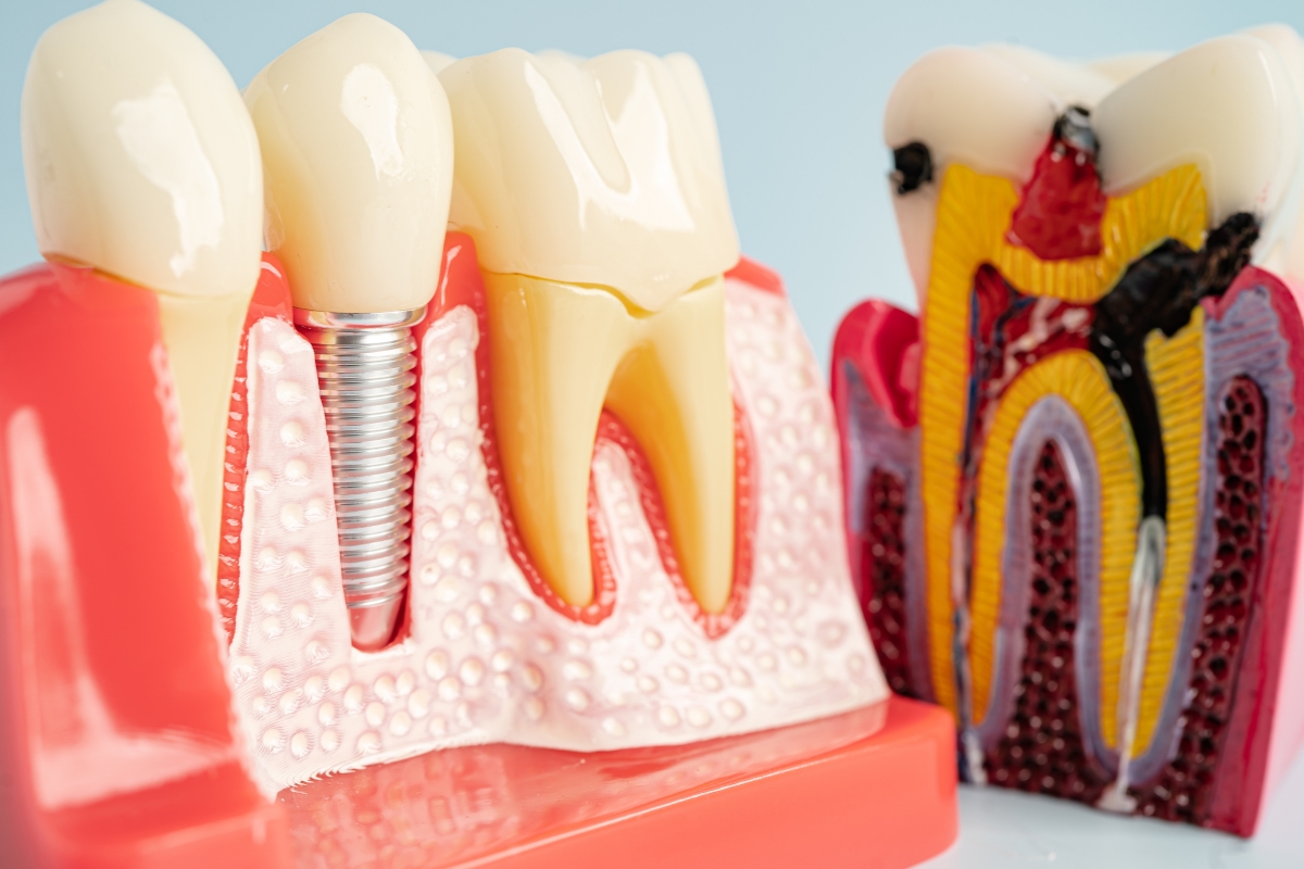 Dental Implants Richmond