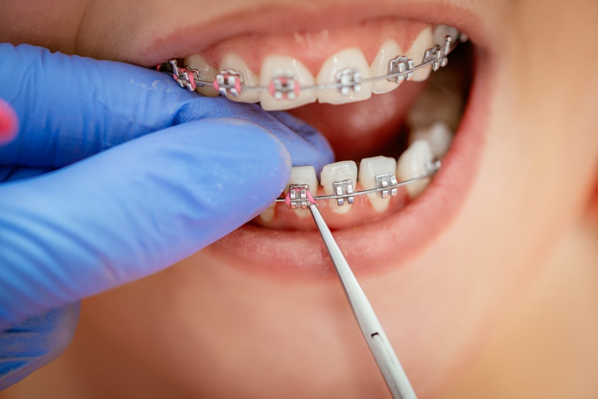 Dental Bridges in Richmond